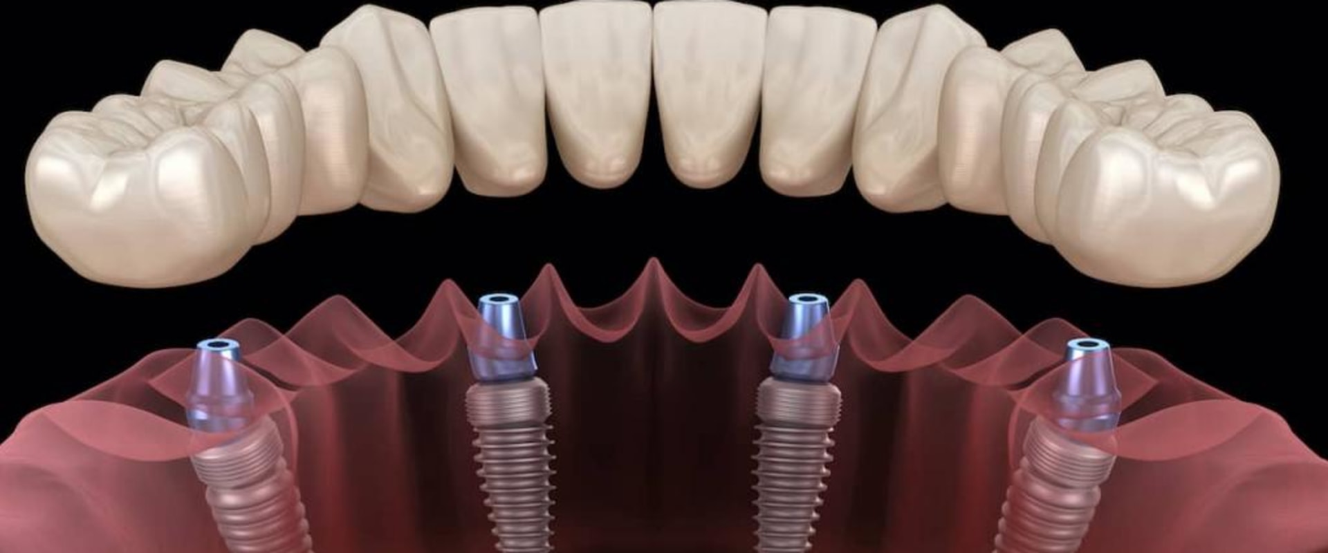 What are the most durable dental implants?