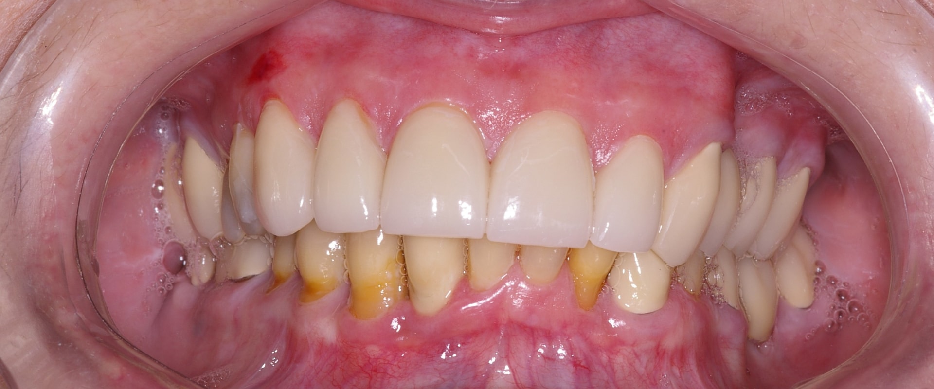 Do veneers permanently damage teeth?