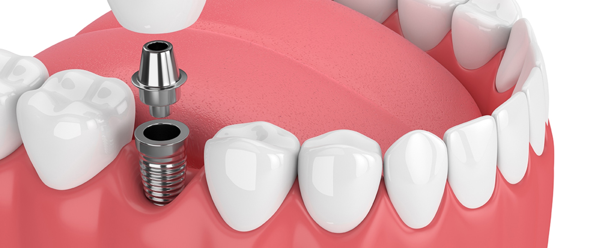 All You Need To Know About Dental Veneers And Dental Implants In Allen, TX