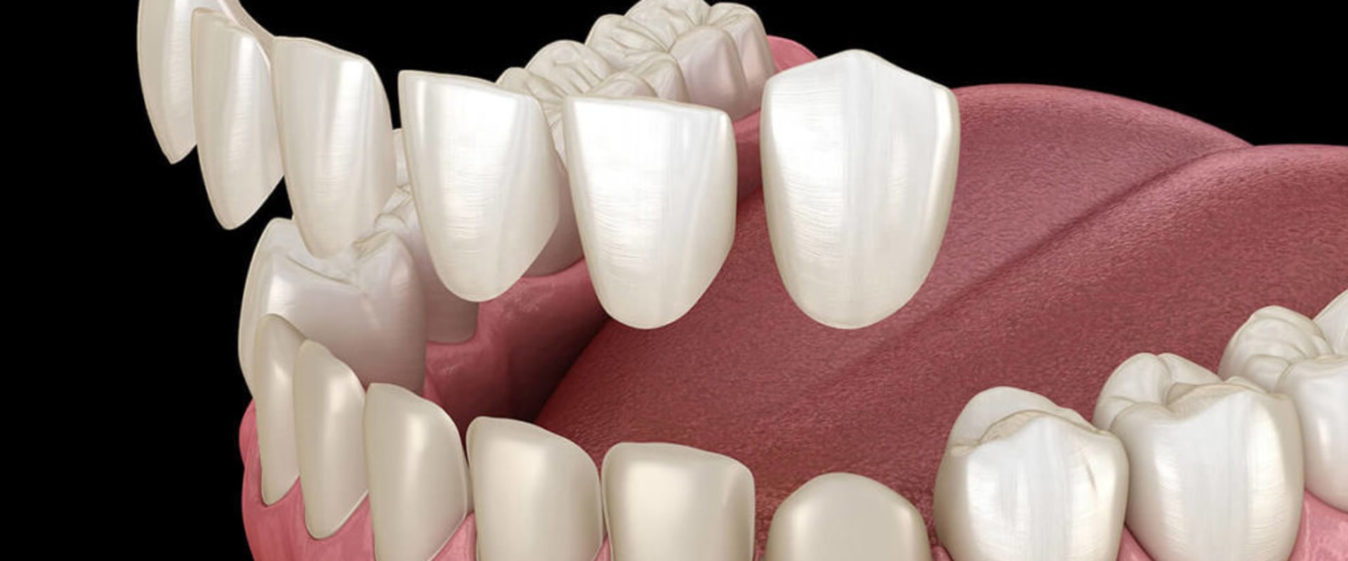 Transform Your Smile With Dental Porcelain Veneers In Sydney