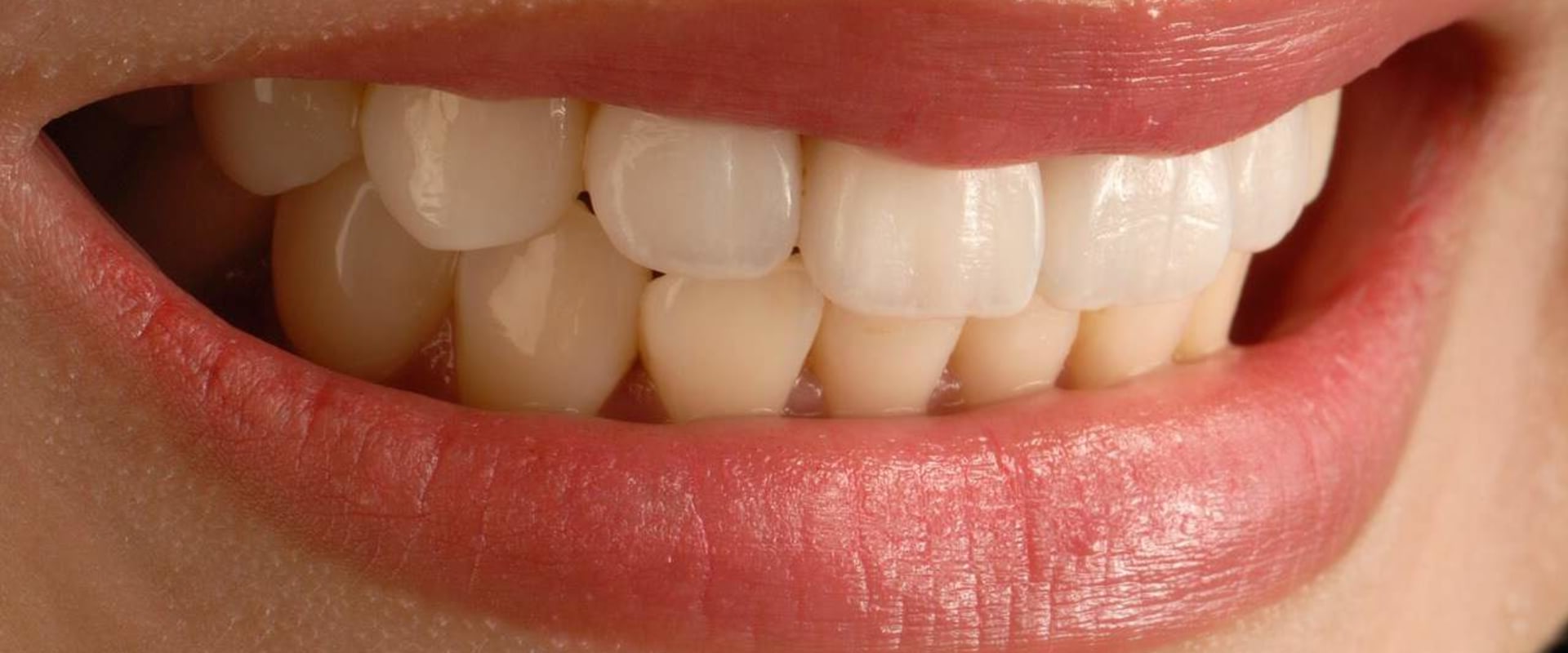 Can veneers cause problems?