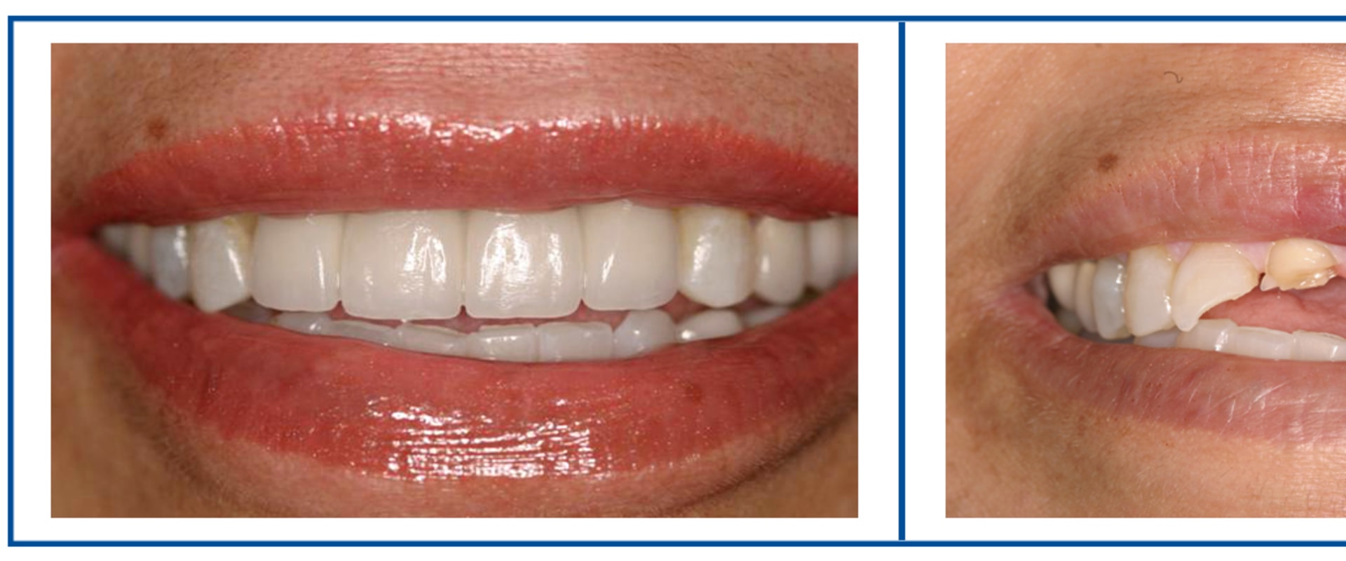 How much is a full set of top veneers?