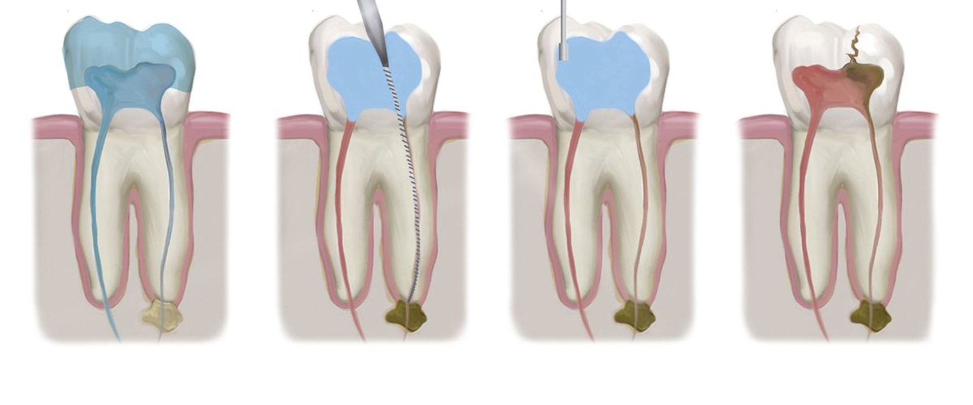 Dental Veneers And Emergency Root Canal Treatment In London: What To Expect