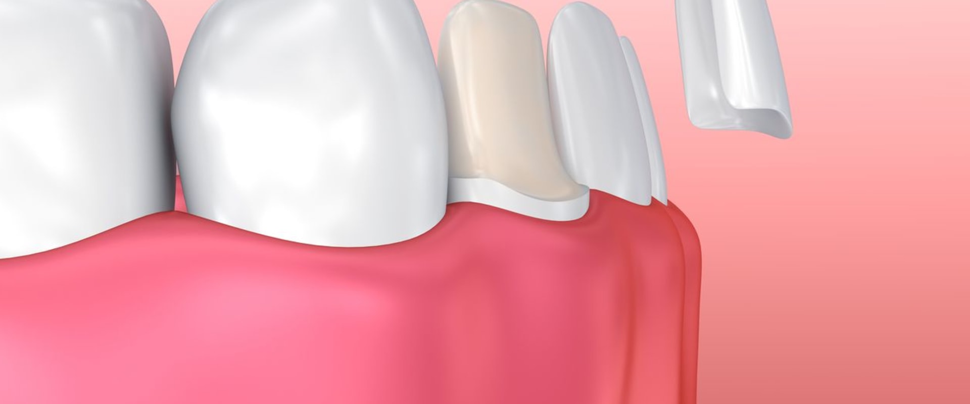 Why Porcelain Veneers Are The Perfect Solution For A Beautiful Smile In San Antonio