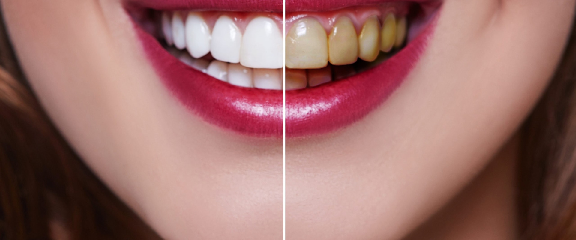 How much does a top row of veneers cost?