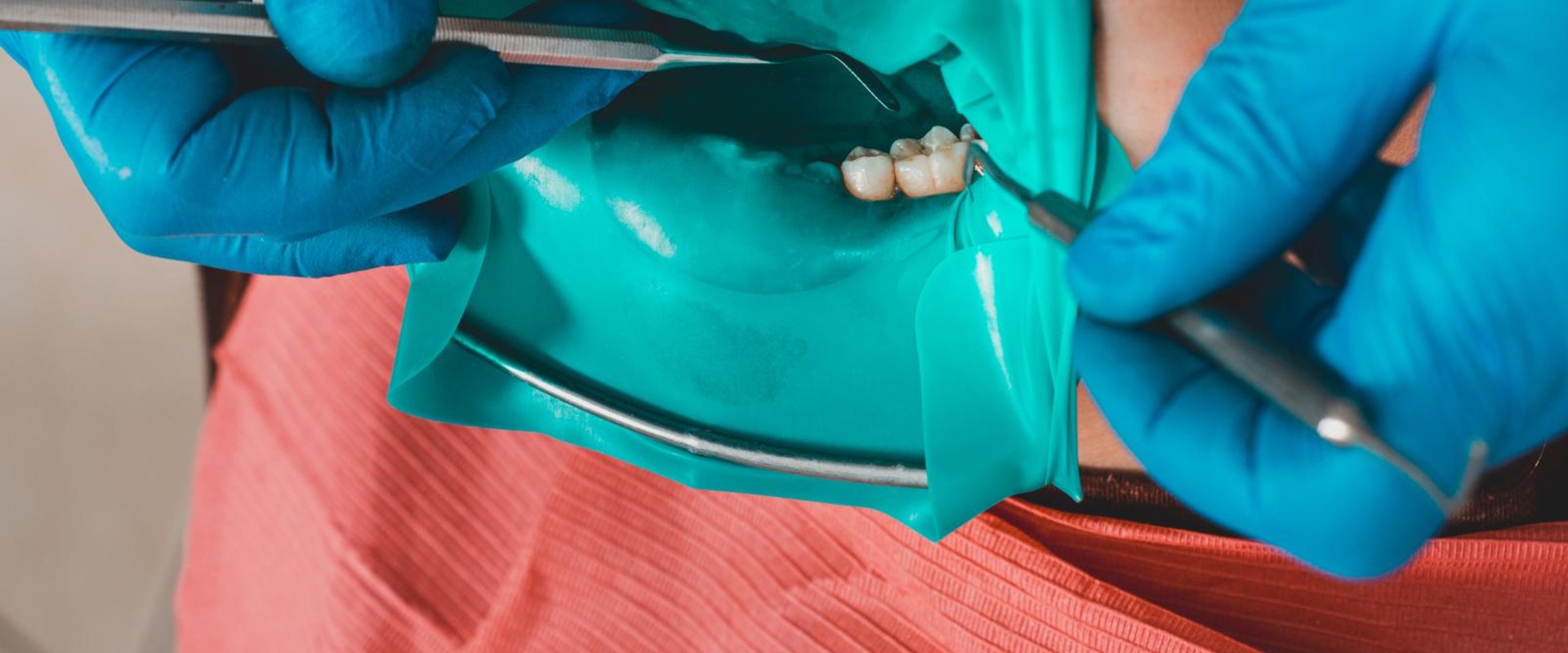 The Benefits Of Choosing A Dental Clinic With Dental Veneers Expertise In Woden