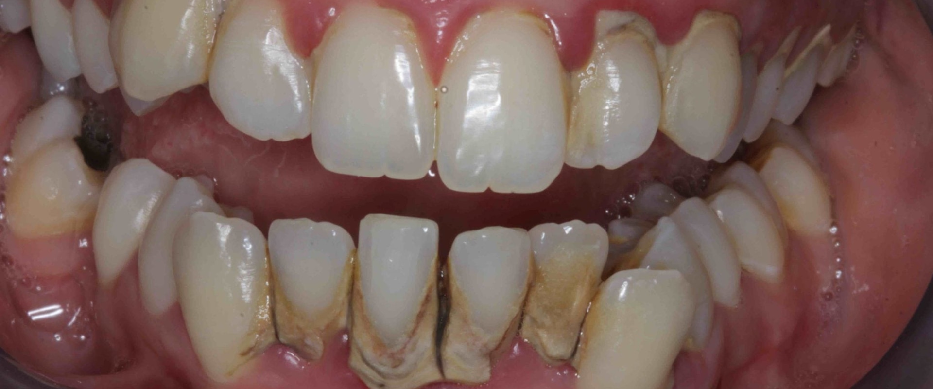 What problems do veneers cause?