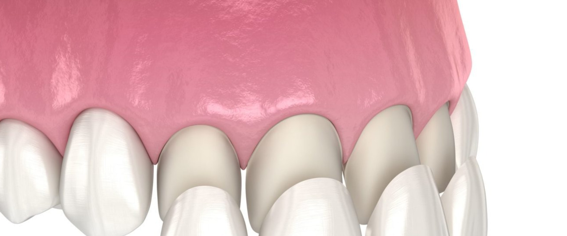 Why are veneers so painful?