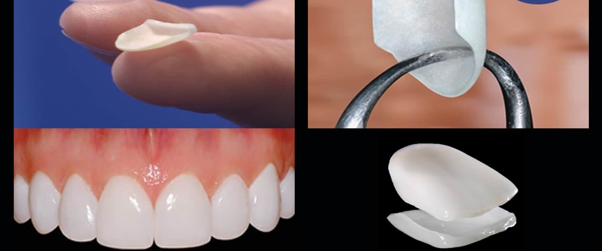 How often do you need veneers redone?