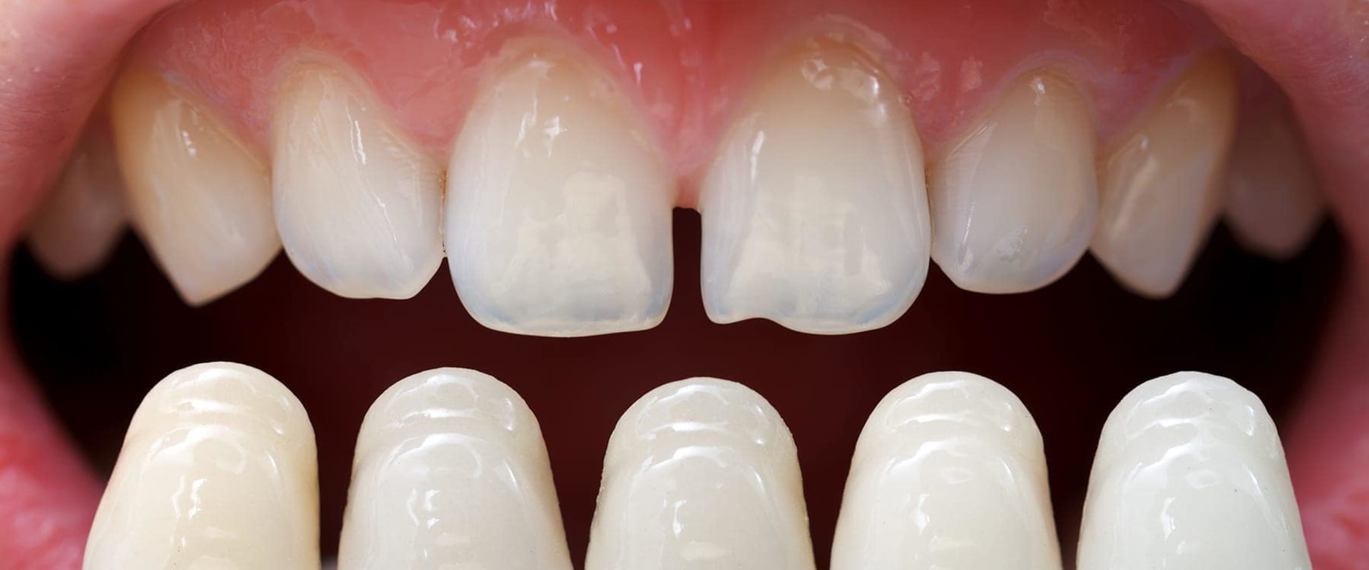 Do you get put to sleep for veneers?