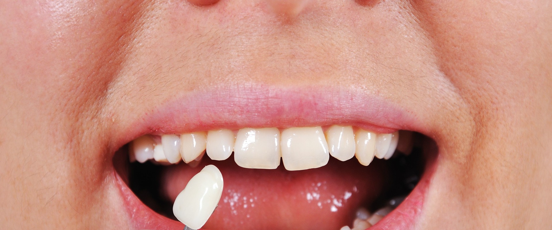 What happens to the teeth under veneers?