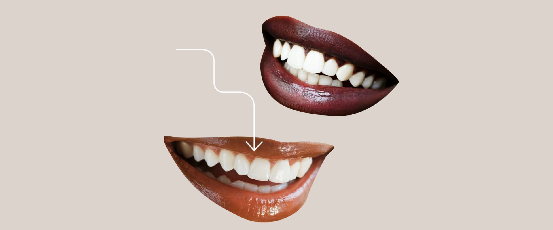 Everything You Need To Consider When Thinking About Getting Dental Veneers In Georgetown And Austin