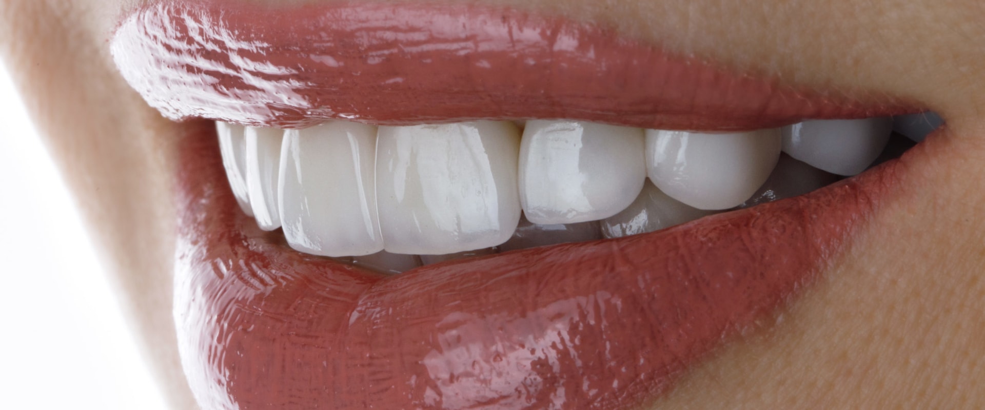 Do veneers come off easily?