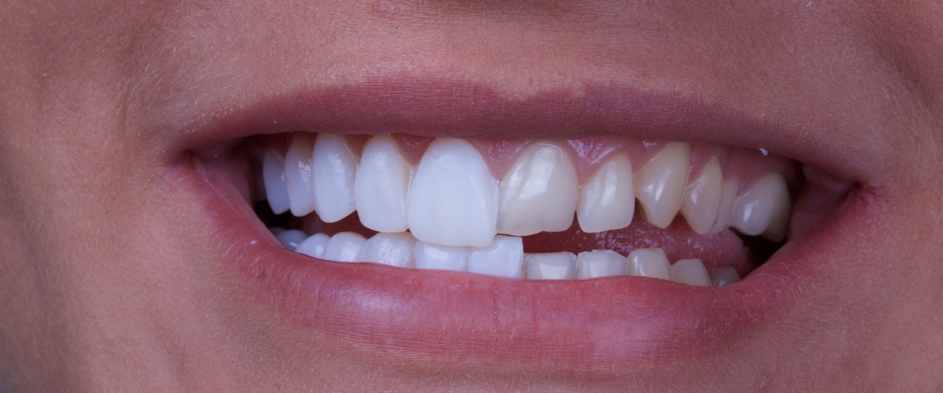 Why dental veneers?