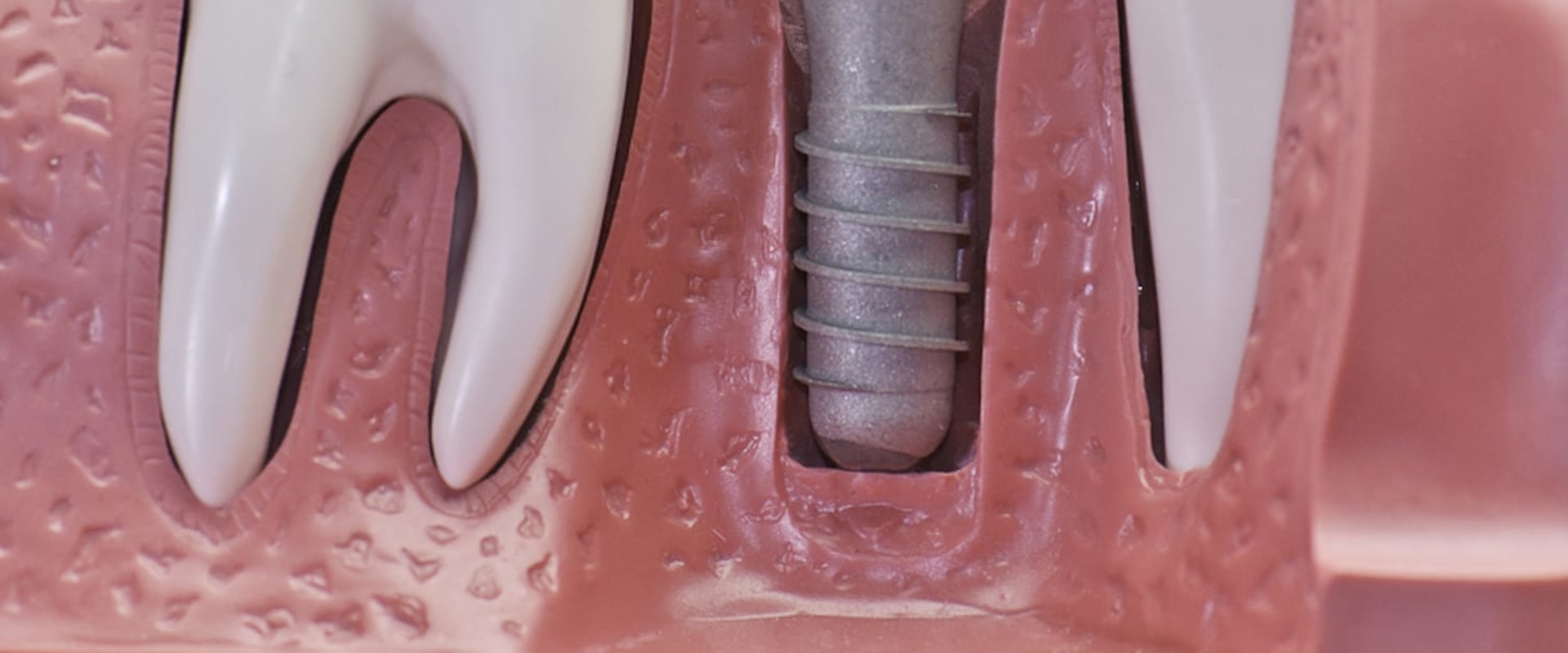 Why dental implants expensive?