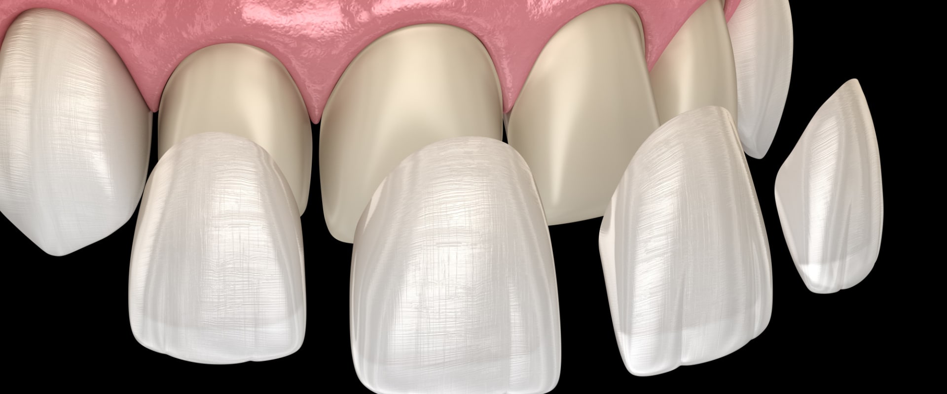 The Complete Guide To Quality Dental And Porcelain Veneers In Cedar Park