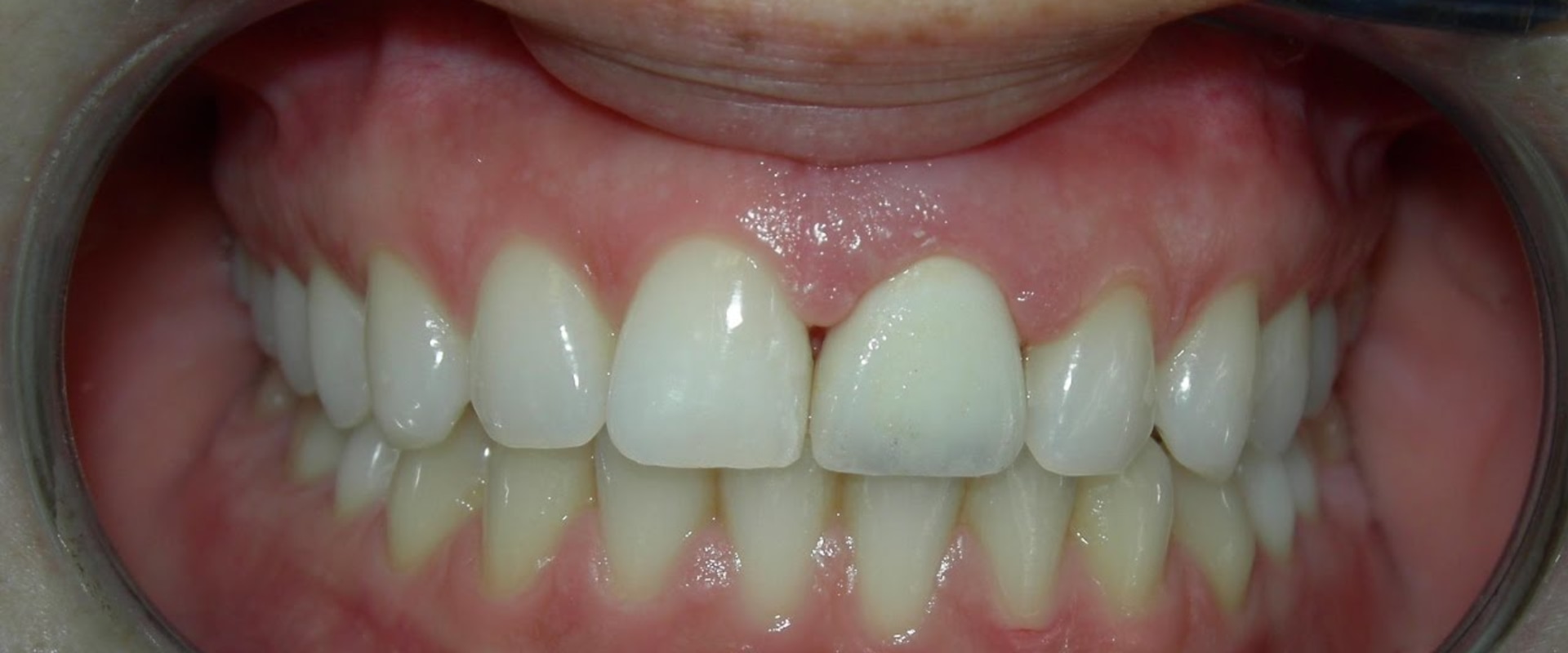 How do you keep veneers from falling off?