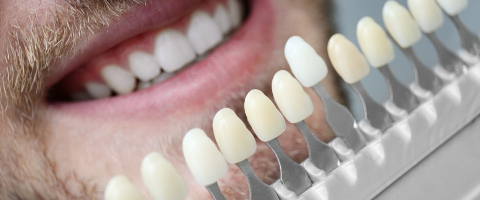 Revamp Your Smile With Dental Veneers And Teeth Whitening In Sydney