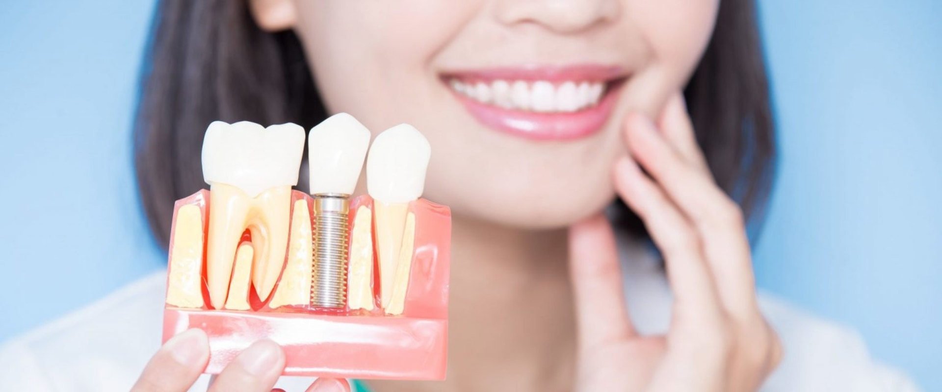 Can you keep veneers forever?