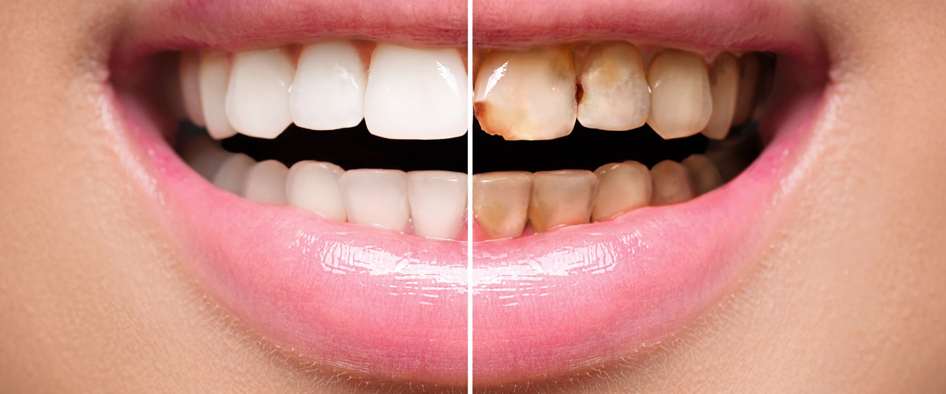Do you still have feeling in your teeth with veneers?