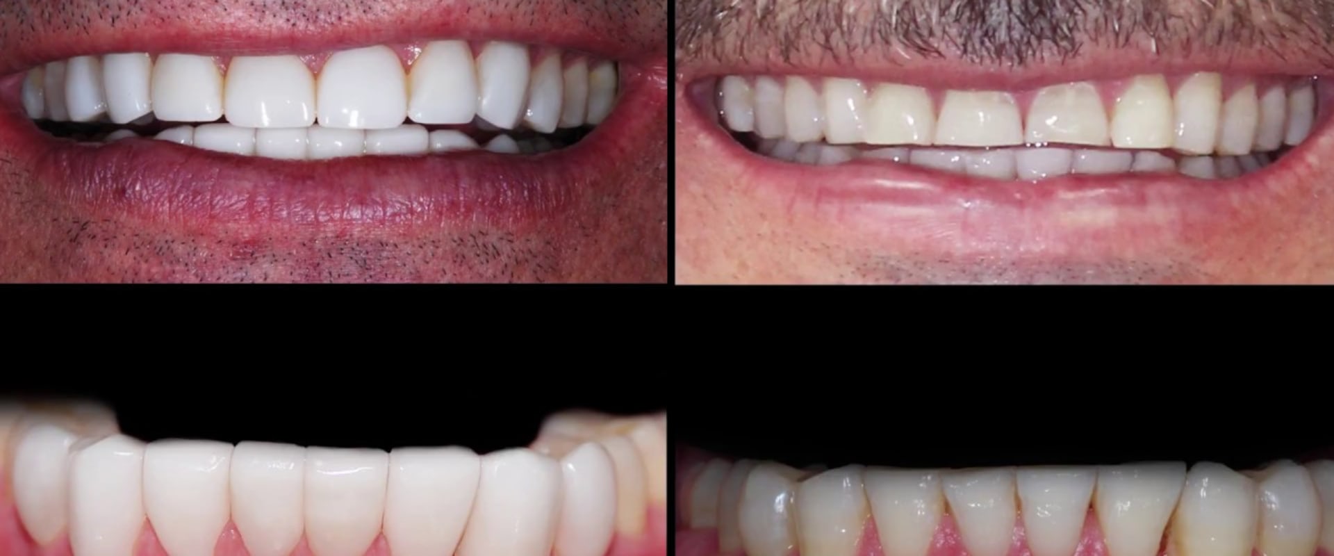 How many veneers do i need for bottom teeth?