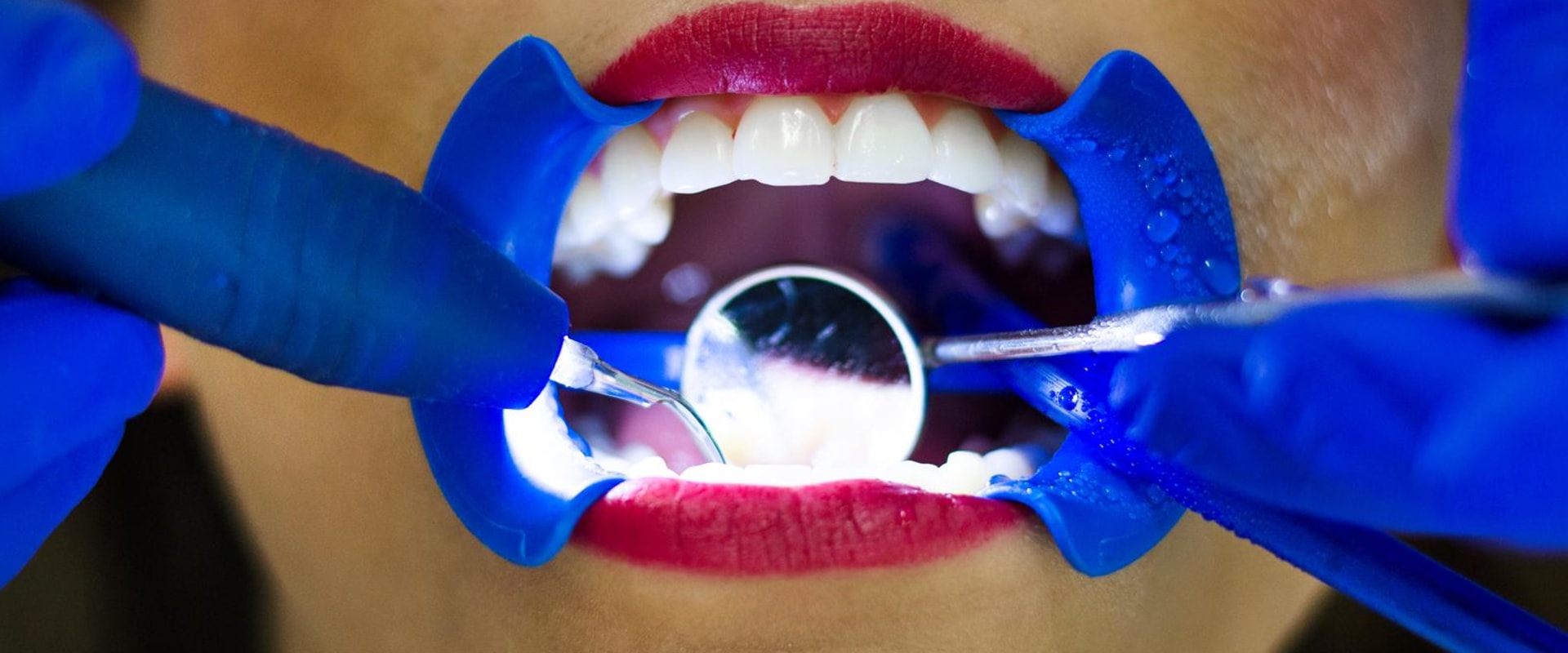 Exploring Different Types Of Dental Veneers In Taylor, TX