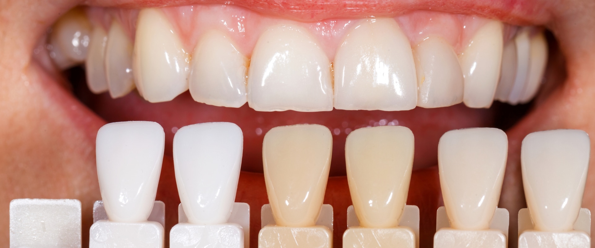 Can veneers be done twice?