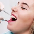 Smile Transformations: Discovering Dental Veneers In Gainesville, VA