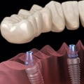 What are the most durable dental implants?