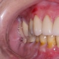 Do veneers permanently damage teeth?