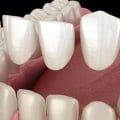 Transform Your Smile With Dental Porcelain Veneers In Sydney