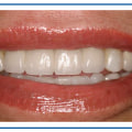 How much is a full set of top veneers?