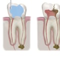 Dental Veneers And Emergency Root Canal Treatment In London: What To Expect