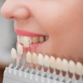 The Ultimate Smile Makeover: Discovering The Power Of Veneers In Austin