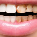 How often do you have to get veneers checked?