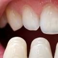Can you get veneers only on top?