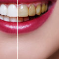 How much does a top row of veneers cost?