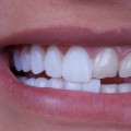 All You Need To Know Before Getting Porcelain Veneers In Round Rock, Texas