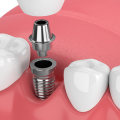 What dental veneers?