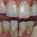 What problems do veneers cause?