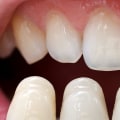 Do you get put to sleep for veneers?
