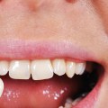 What happens to the teeth under veneers?