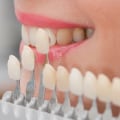 The Ultimate Smile Upgrade: Porcelain Veneers In Spring Branch, TX