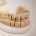 What are disadvantages of veneers?