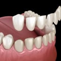 How long does it take for a veneer to settle?