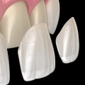 Why Dental Veneers In Waco Are Worth The Investment