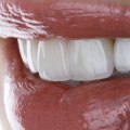 Do veneers come off easily?