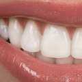 Dental Veneers In Spring, TX: A Guide To Transform Your Smile With Porcelain