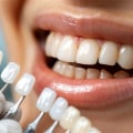 Transform Your Smile with Dental Veneers in Kilchberg