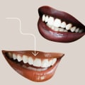 Exploring The Different Types Of Dental Veneer Procedures Available In Mansfield
